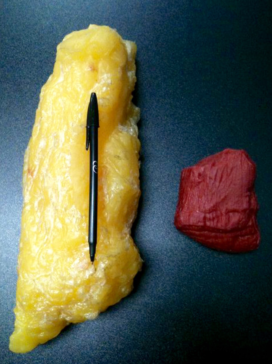 Fat vs. Muscle: Understanding The Truth Behind The Images